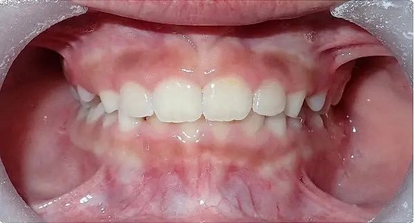 Before & After Orthodontic Images Aventura FL