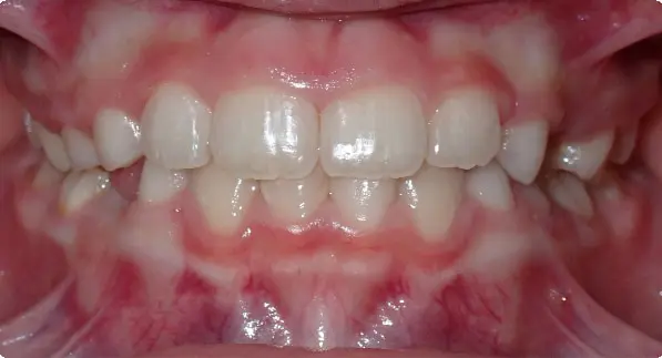 Before & After Orthodontic Images Aventura FL