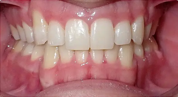 Before & After Orthodontic Images Aventura FL