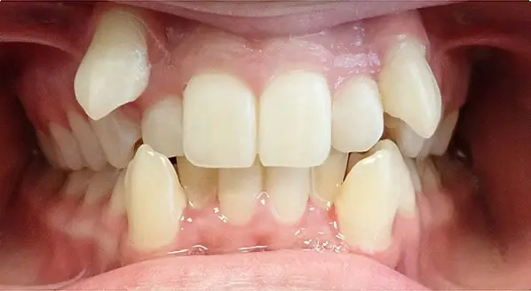 Before & After Orthodontic Images Aventura FL