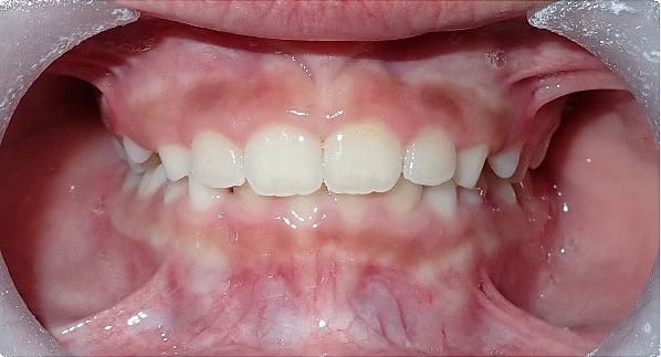 Before & After Orthodontic Images Aventura FL