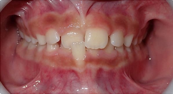 Before & After Orthodontic Images Aventura FL