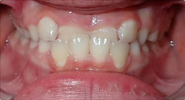 Before & After Orthodontic Images Aventura FL
