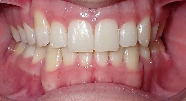 Before & After Orthodontic Images Aventura FL