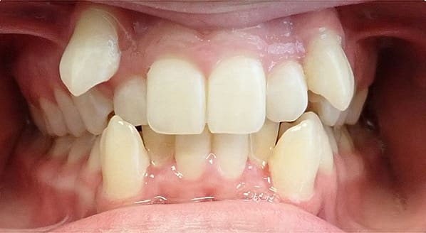 Before & After Orthodontic Images Aventura FL